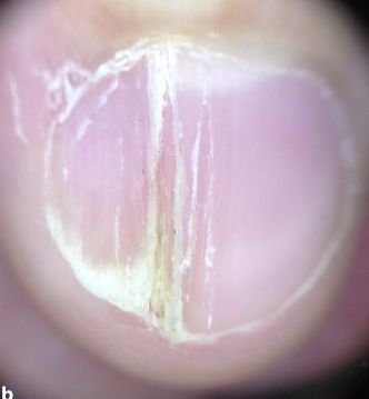 孩子指甲軟薄易斷、月牙少、長(zhǎng)白點(diǎn)、豎紋是顯示身體有健康風(fēng)險(xiǎn)嗎？(圖11)