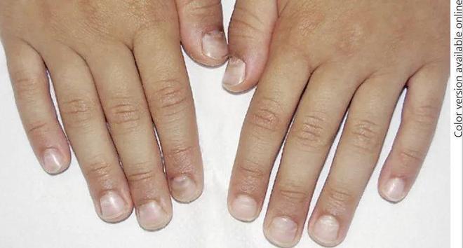 孩子指甲軟薄易斷、月牙少、長(zhǎng)白點(diǎn)、豎紋是顯示身體有健康風(fēng)險(xiǎn)嗎？(圖10)
